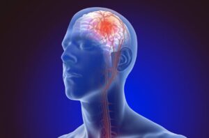 Read more about the article Waspadai Penyusutan Otot yang Menghambat Pemulihan Pasca Stroke